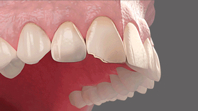 Faccette Dentali non invasive Elite - Ritrova il sorriso velocemente