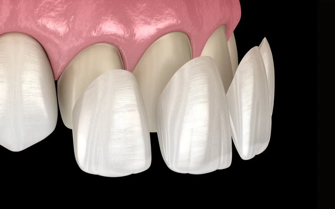 Quanto costano le faccette dentali Elite senza limatura?